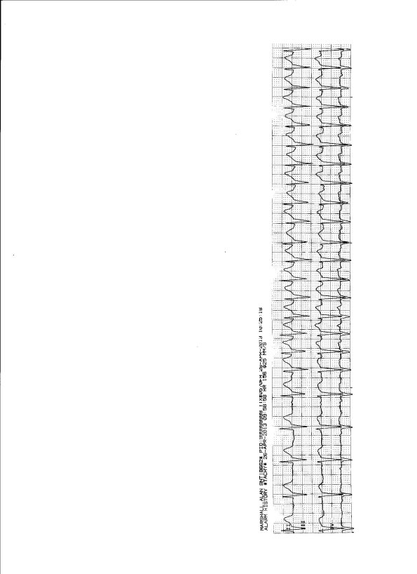 PAC EKG 4 26 13